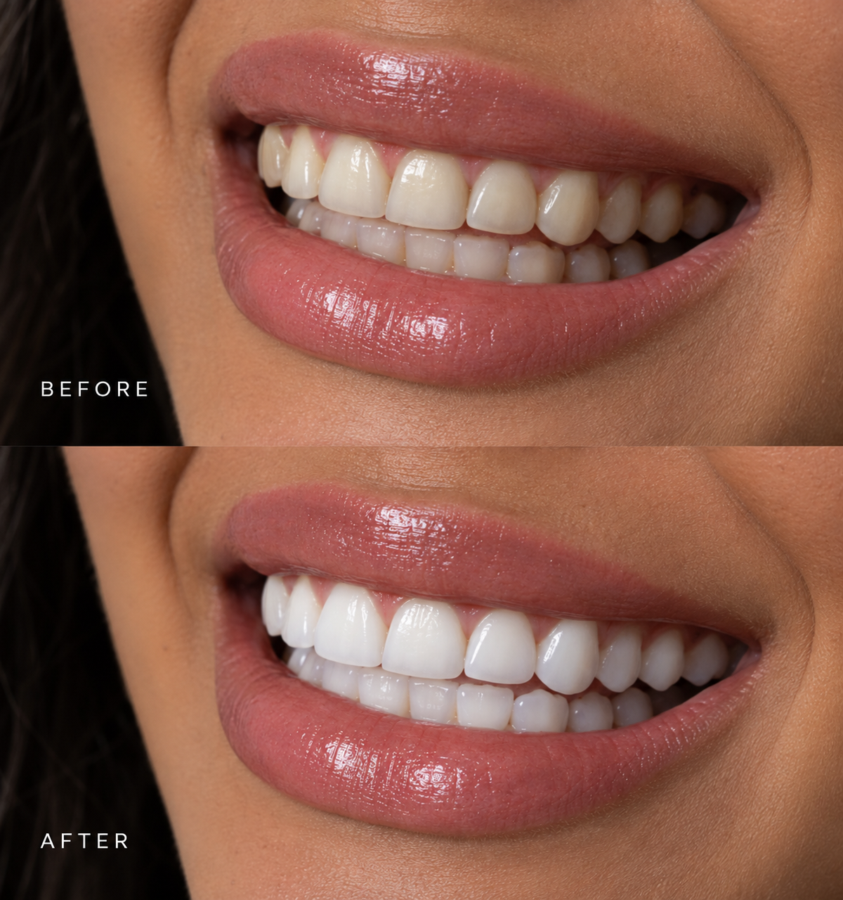 Teeth Whitening Strips™
