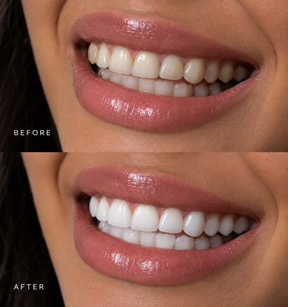 Teeth Whitening Strips™
